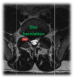 disc-herniation-1