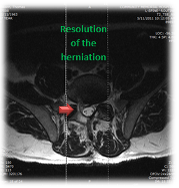 disc-herniation-2