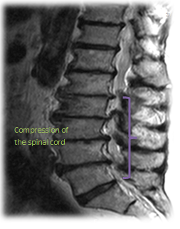 spinal-stenosis-1