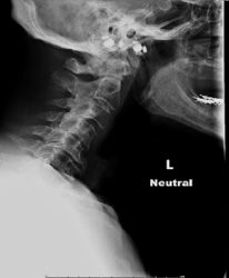 Spine X-Ray Left