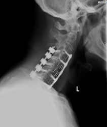 Spine X-Ray Right